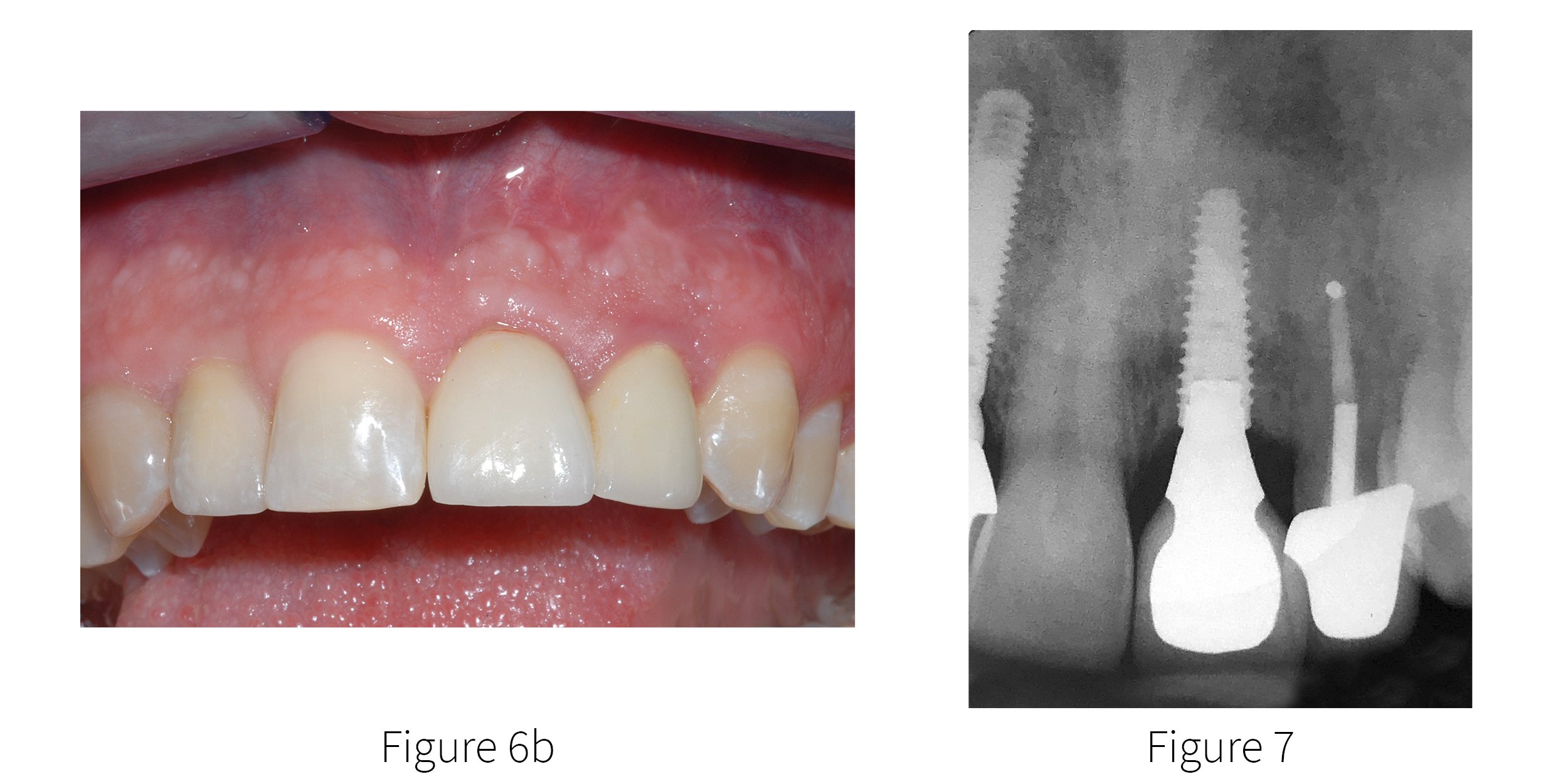 Maxillary Central Incisor Implant Supported Crown - Brief Case Report